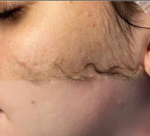 Dermaplaning (depilación del Rostro) - Miniatura 1