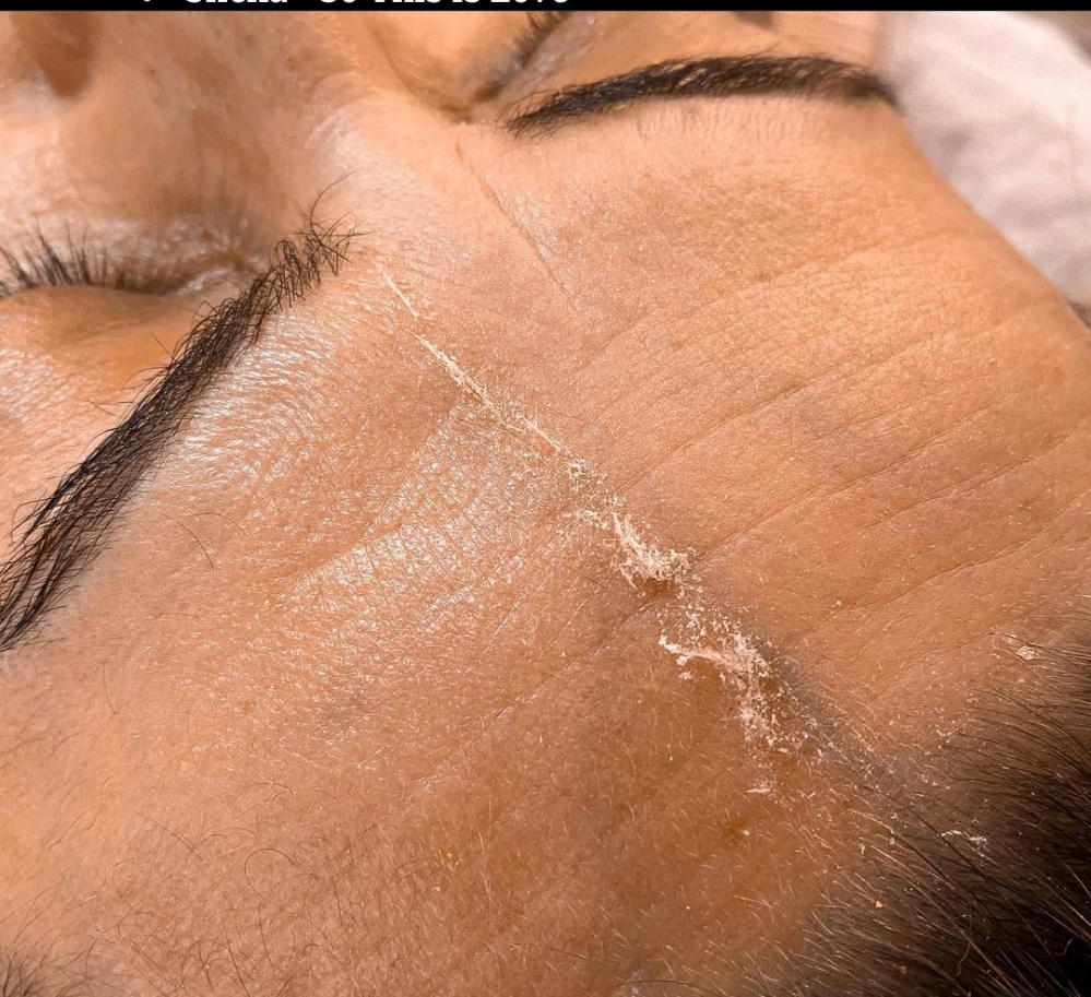 Dermaplaning (depilación del Rostro) - Imagen 3